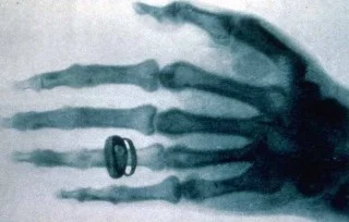 Een van de eerste röntgenfoto's gemaakt van de hand van Alfred von Kolliker