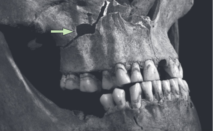 Deel van de schedel van Richard III (The Lancet)