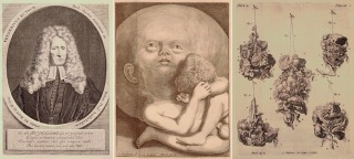 Portret van Frederik Ruysch op 85 jarige leeftijd. Daarnaast kopergravuren van het kind en de vijf weefselfragmenten. Gediagnosticeerd als een intracranieel teratoom met foetale kenmerken. De vroegste beschrijving tot nu toe.