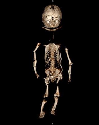 CT scan babypop (LUMC)