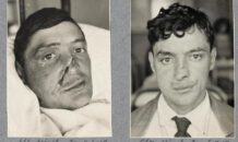 ‘Facemaker’ Harold Gillies gaf verminkte soldaten in WOI hun waardigheid terug