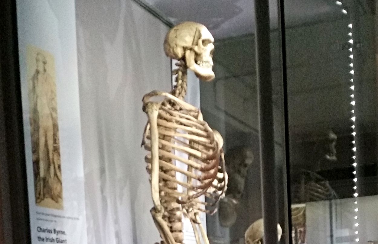 Skelet van Charles Byrne, zoals eerder te zien in het Hunterian Museum