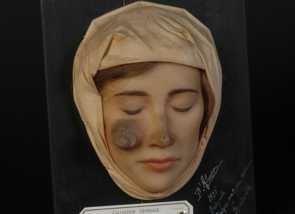 Een jonge vrouw die lijdt aan de ‘Maladie de Bagdad' (Leishmaniasis)