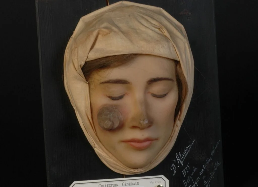 Een jonge vrouw die lijdt aan de ‘Maladie de Bagdad' (Leishmaniasis)