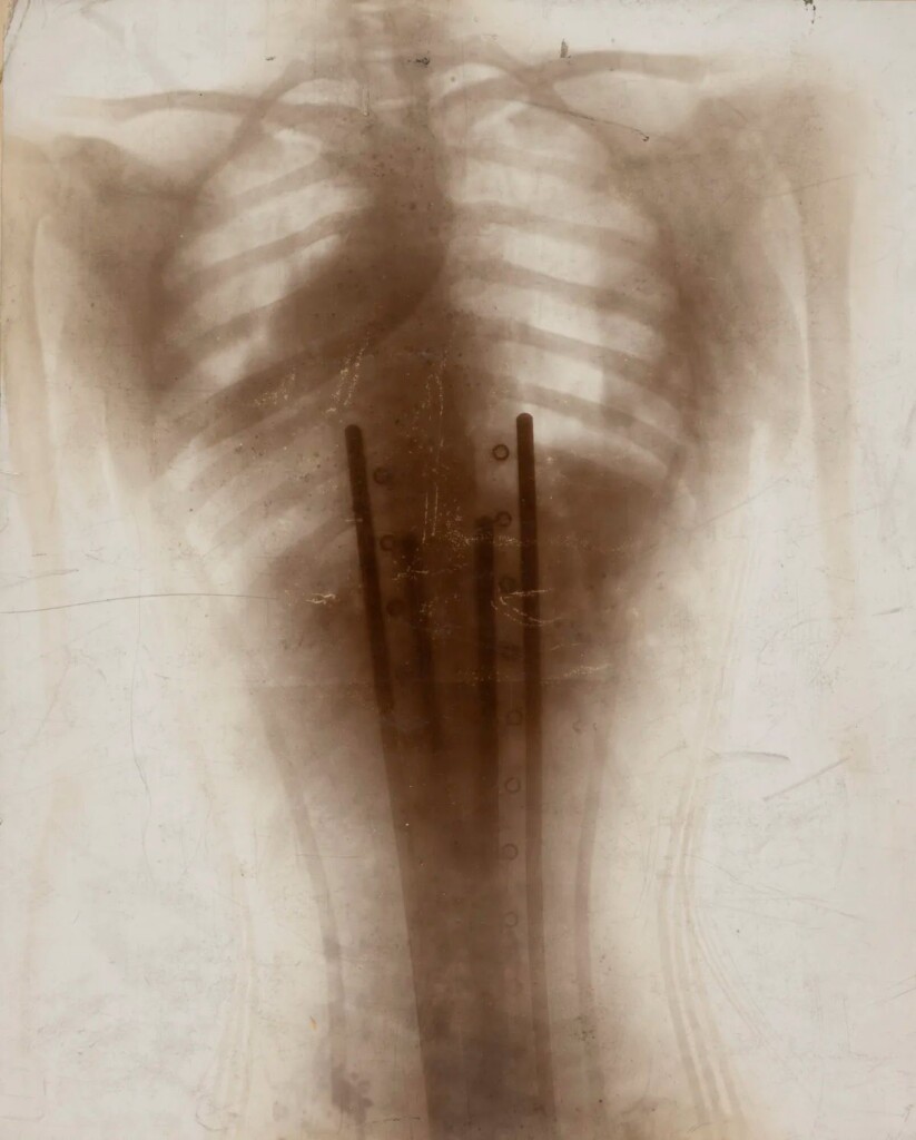 rontgenfoto 1896